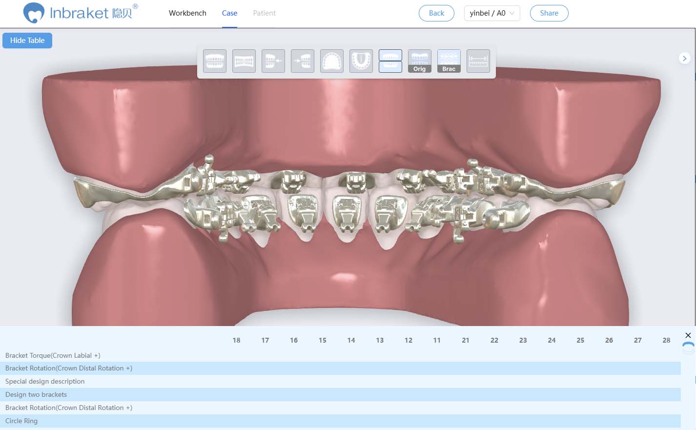 InBracket Customized Lingual Bracket System - FN Orthodontics