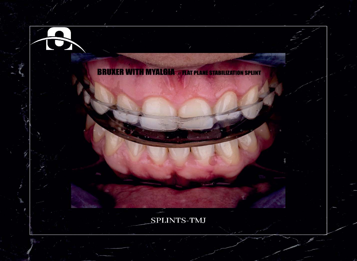 Splints TMJ FN Orthodontics