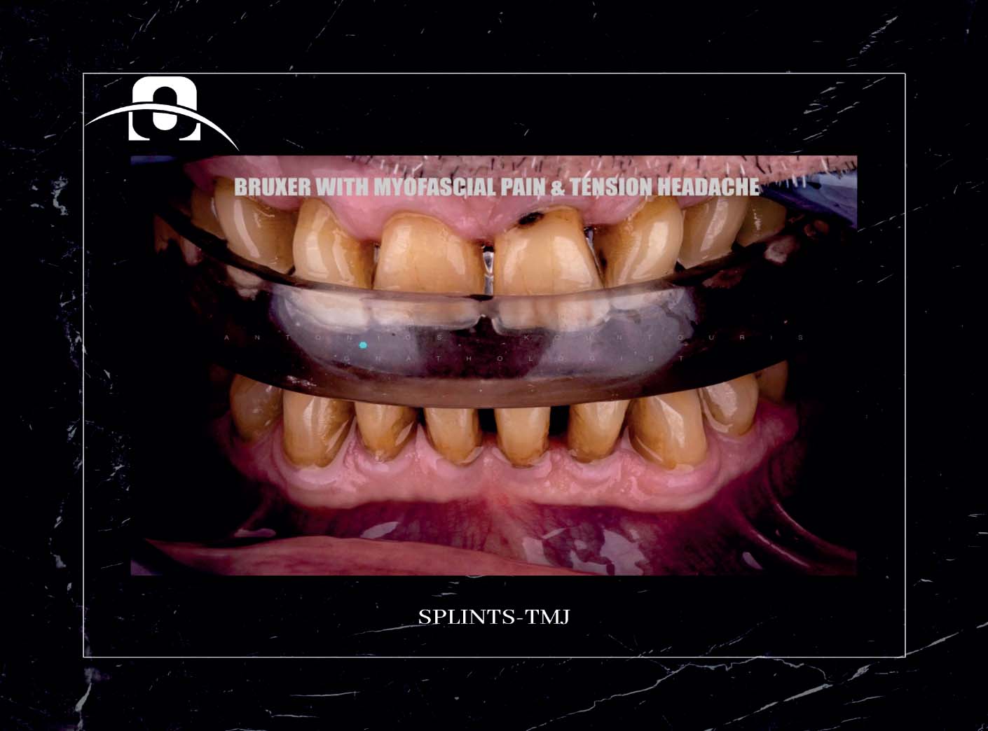 Splints TMJ FN Orthodontics